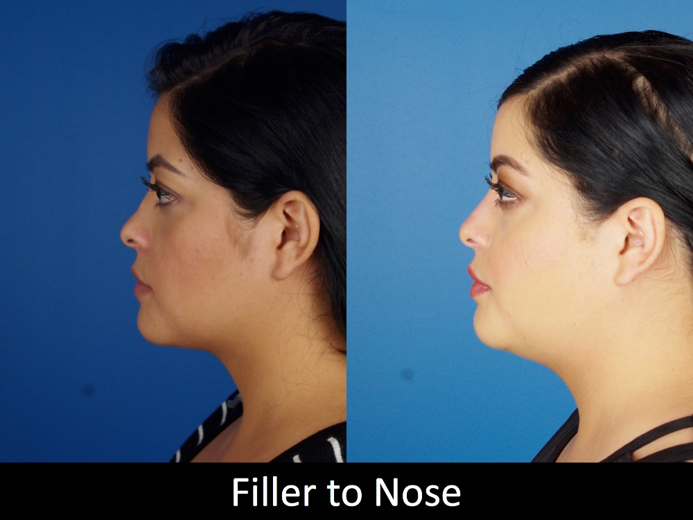 Botox And Fillers Before And Afters Raval Facial Aesthetics Denver